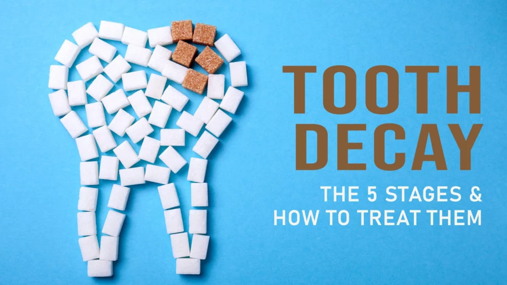 TOOTH DECAY: THE 5 STAGES AND HOW TO TREAT THEM